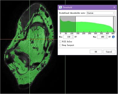 The feasibility of diagnosing sprained ankle via 3D MRI reconstructing three-dimensional model of anterior talofibular ligament